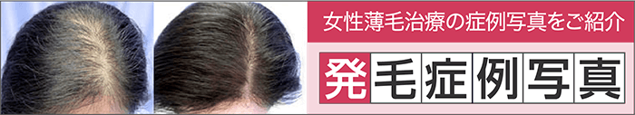 発毛症例写真