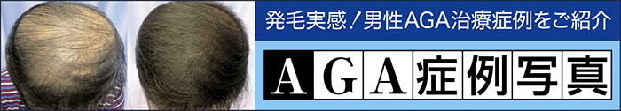 AGA症例写真